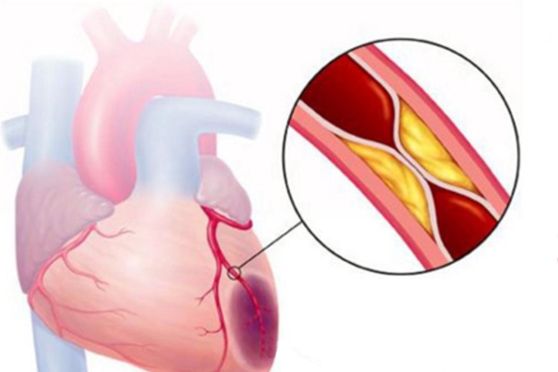 cardiopatia ischemica