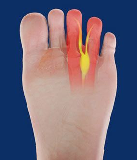 neuroma di morton