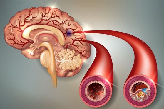 riabilitazione post-ictus