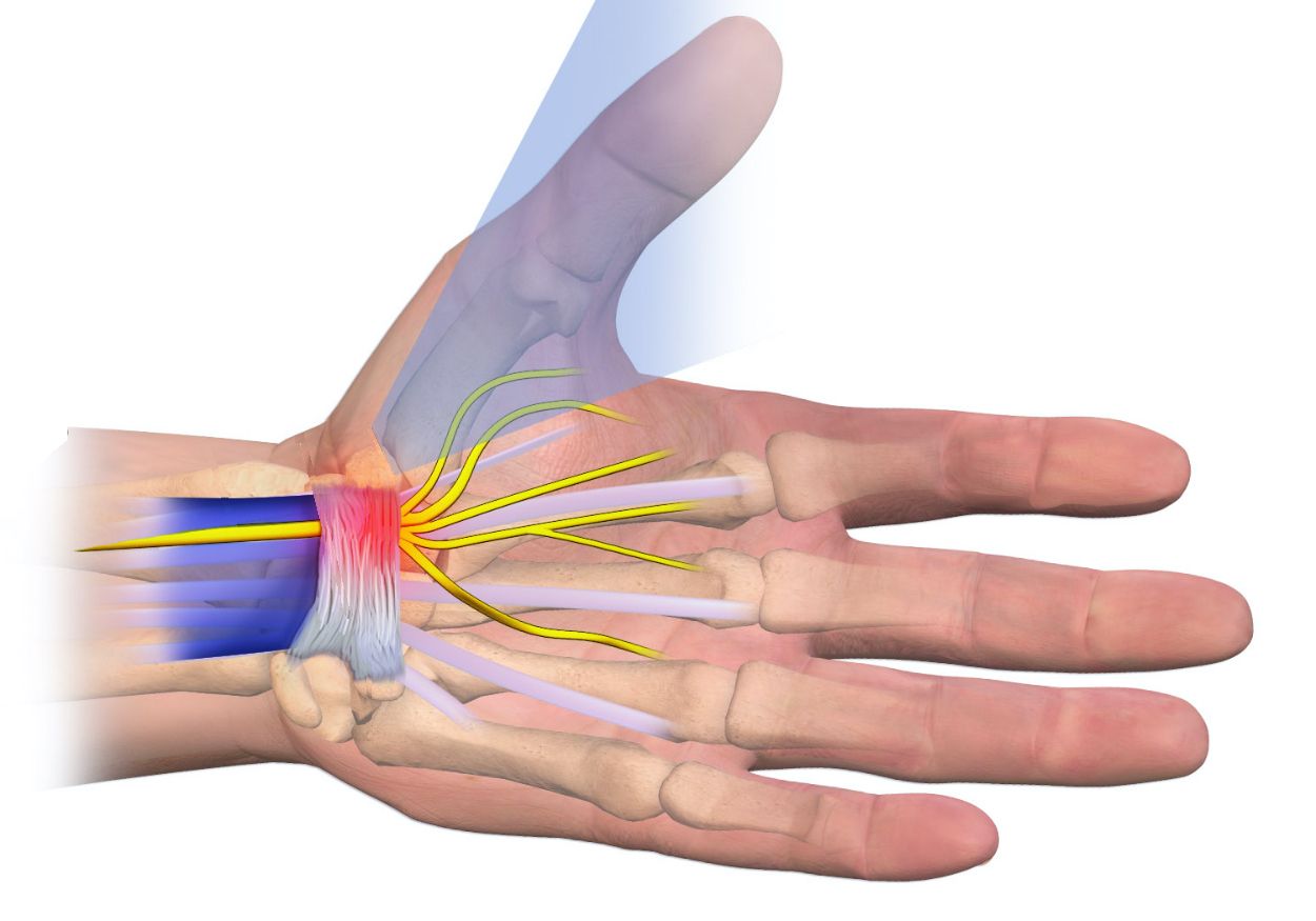 SINDROME DEL TUNNEL CARPALE